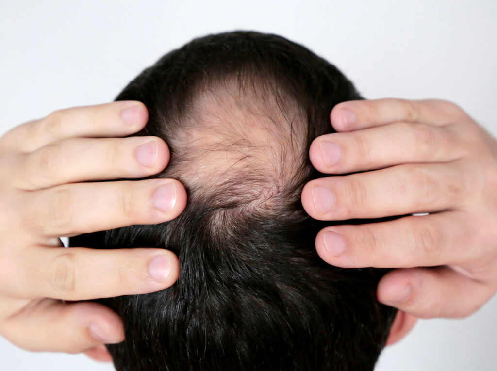 picture showing a man with a tonsure on top of his head