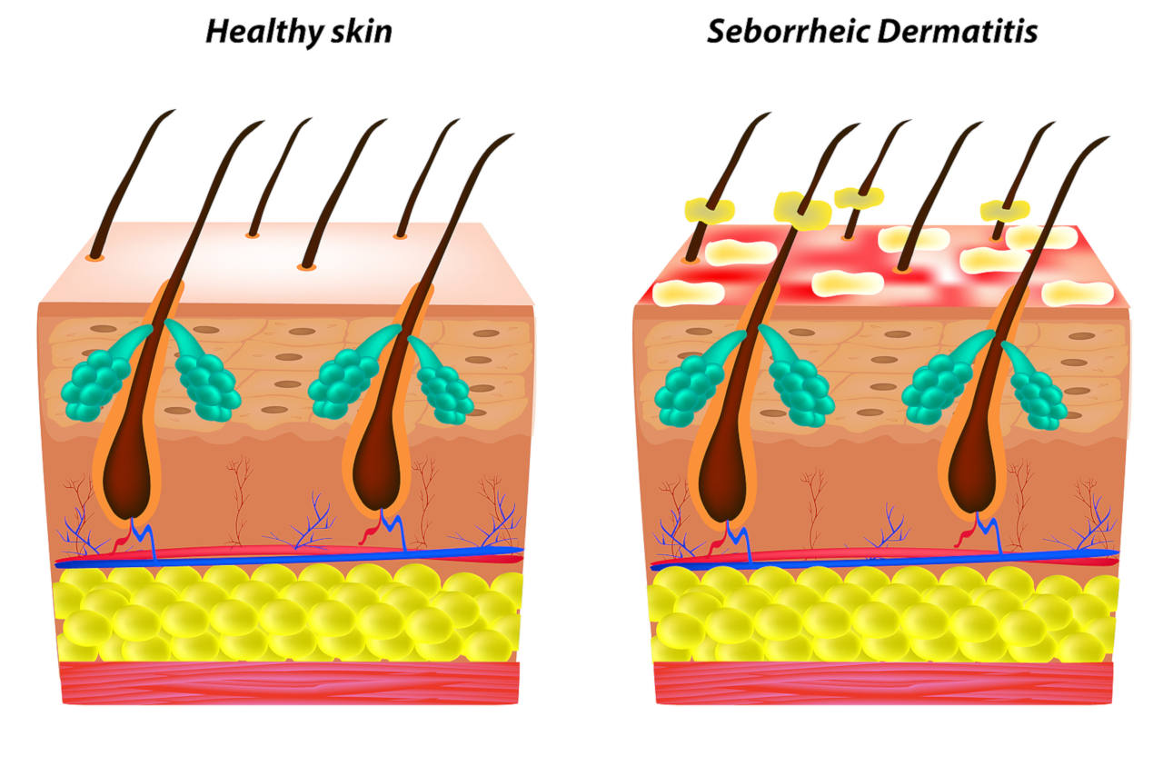 seborrheic dermatitis is the most common cause of an itchy scalp