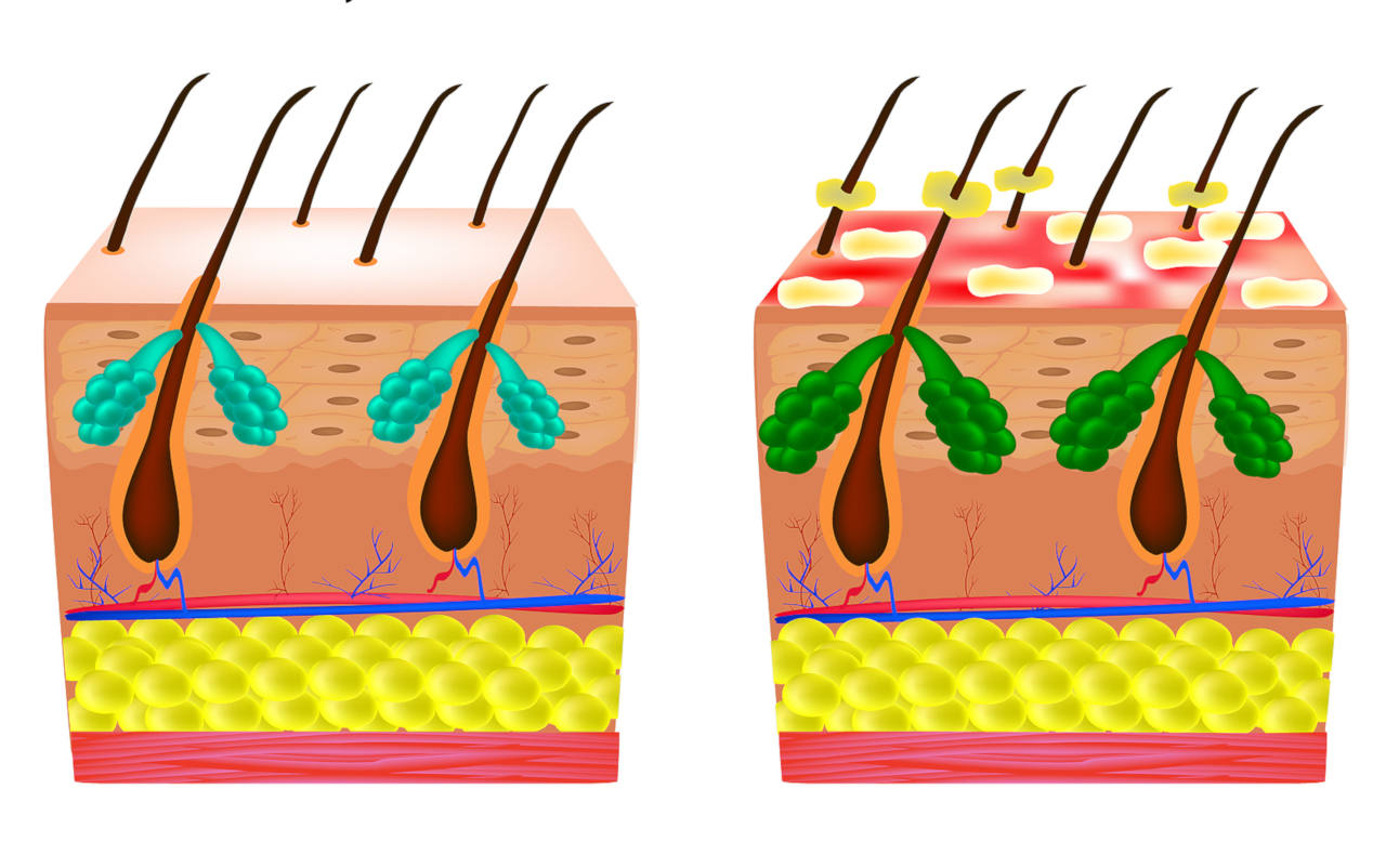 Hair Follicle Fungus