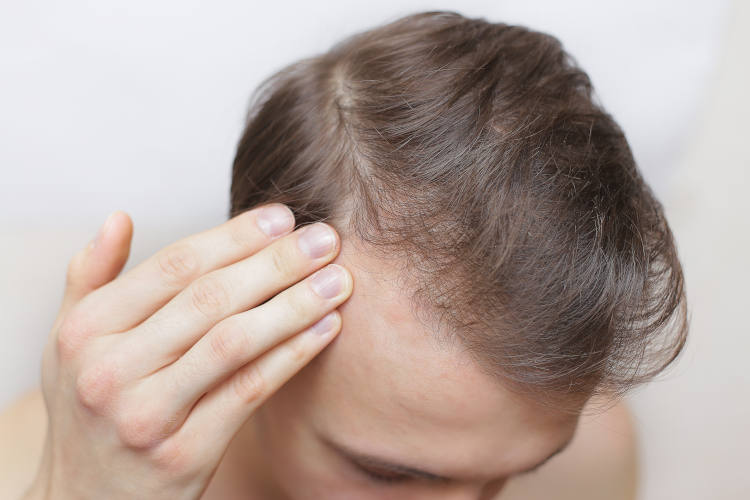 Man moving his hand through his hair and examining for hair loss