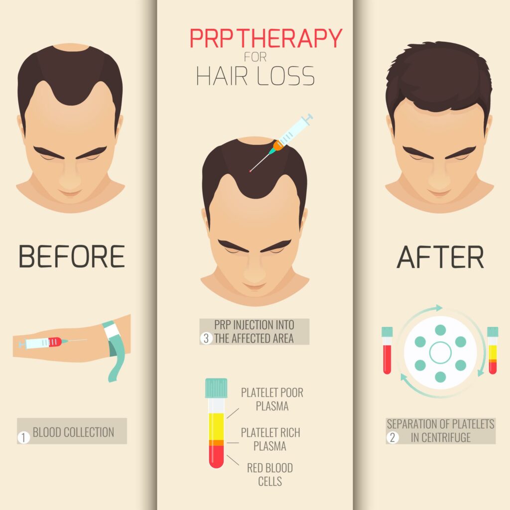 Diagram of PRP hair treatment showing procedure