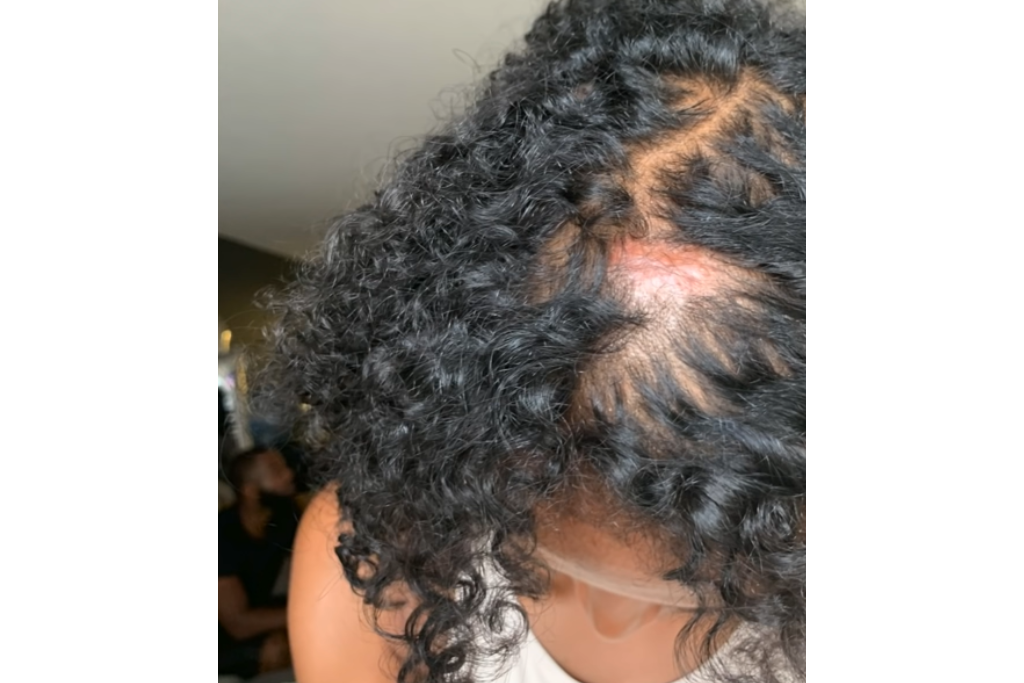 Woman with alopecia on top of scalp after using synthetic hair