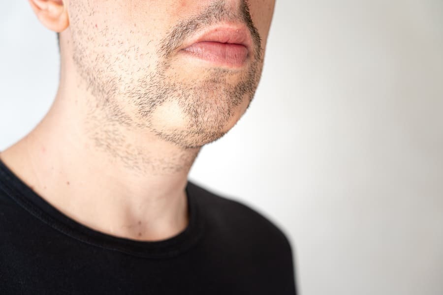 Primer plano de un hombre que padece de la enfermedad autoinmune alopecia areata en la barba