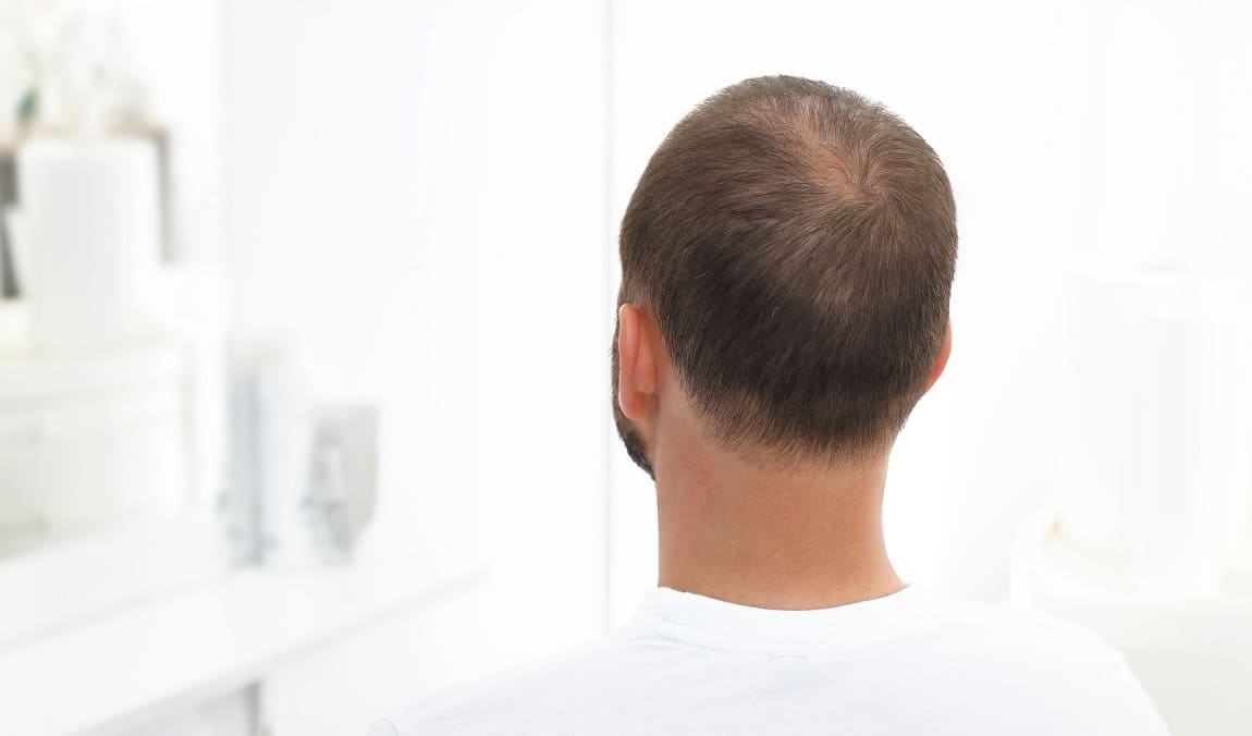 5 verschiedene Gründe für dünnes Haar beim Mann