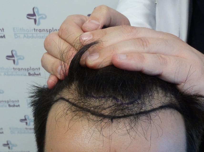 Arten von Haarersatz - gezeichnete natürliche Haarlinie vor Haartransplantation