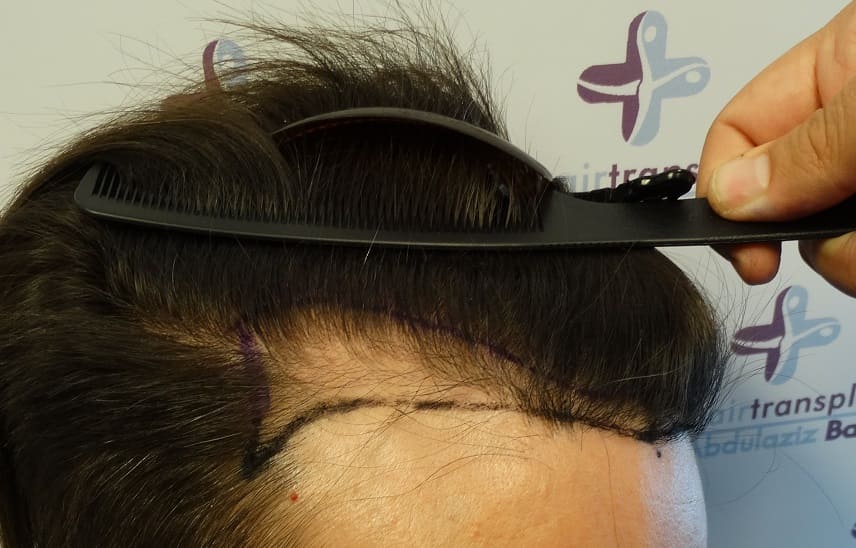 Haarausfall durch einen Sonnenbrand - Vor der Behandlung bei Haarausfall - Elithairtransplant