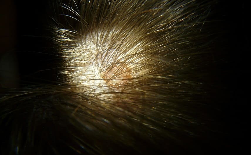 Lichen ruber mit Haarausfall