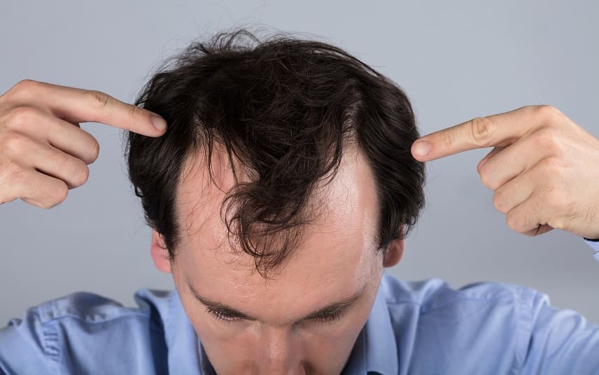 Thymuskin gegen Haarausfall - Junge Mann zeigt sein Geheimratsecken