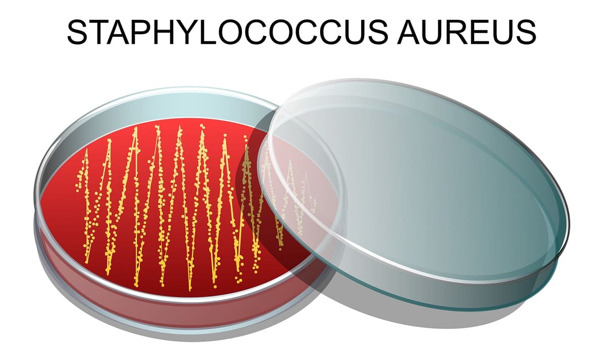 Haarausfall durch Staphylococcus aureus