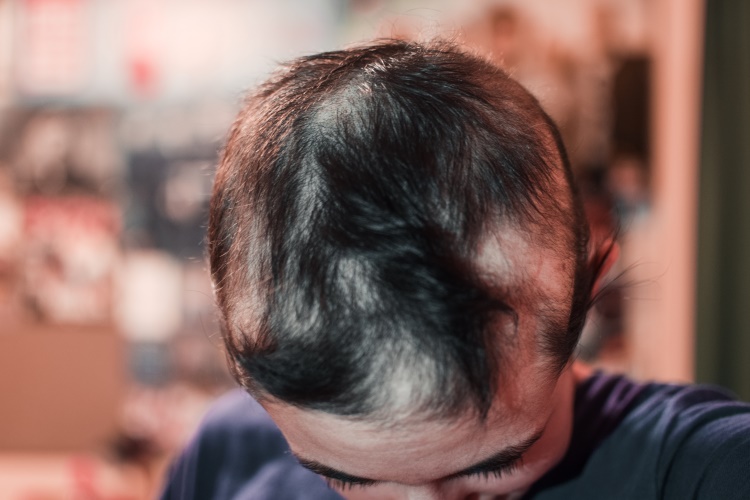 Kopf eines Mannes mit diffusem Haarausfall durch eine bakterielle Infektion